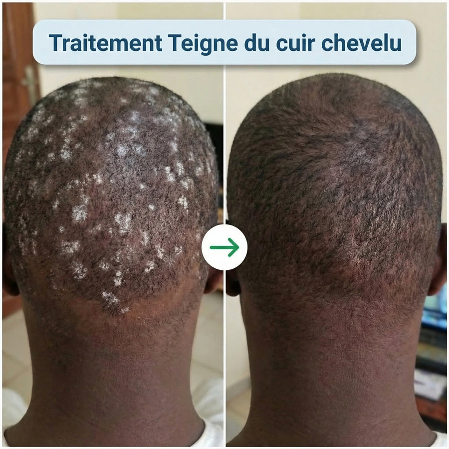 Savon Antifongique + Crème Antibactérienne Offerte -  Traitement Anti démangeaisons